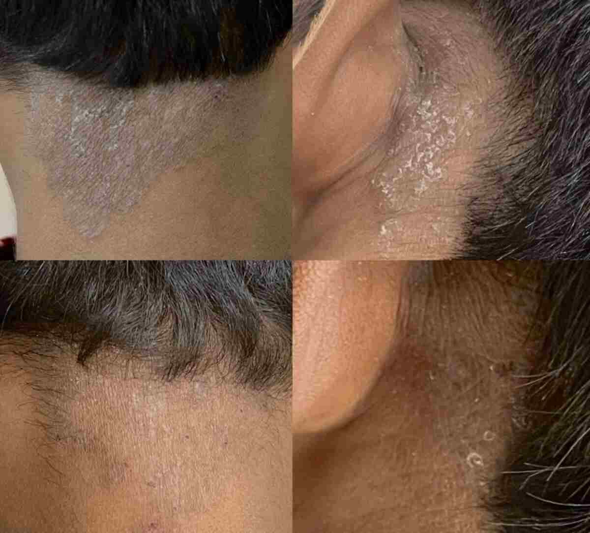 After Years of Creams and Medication, Single Laser Session Clears Psoriasis in Young Male